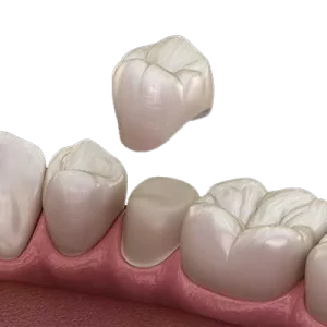 Dental Crown, Θήκη Δοντιού