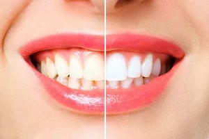 Yellow Teeth Before And After