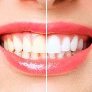 Yellow teeth before and after